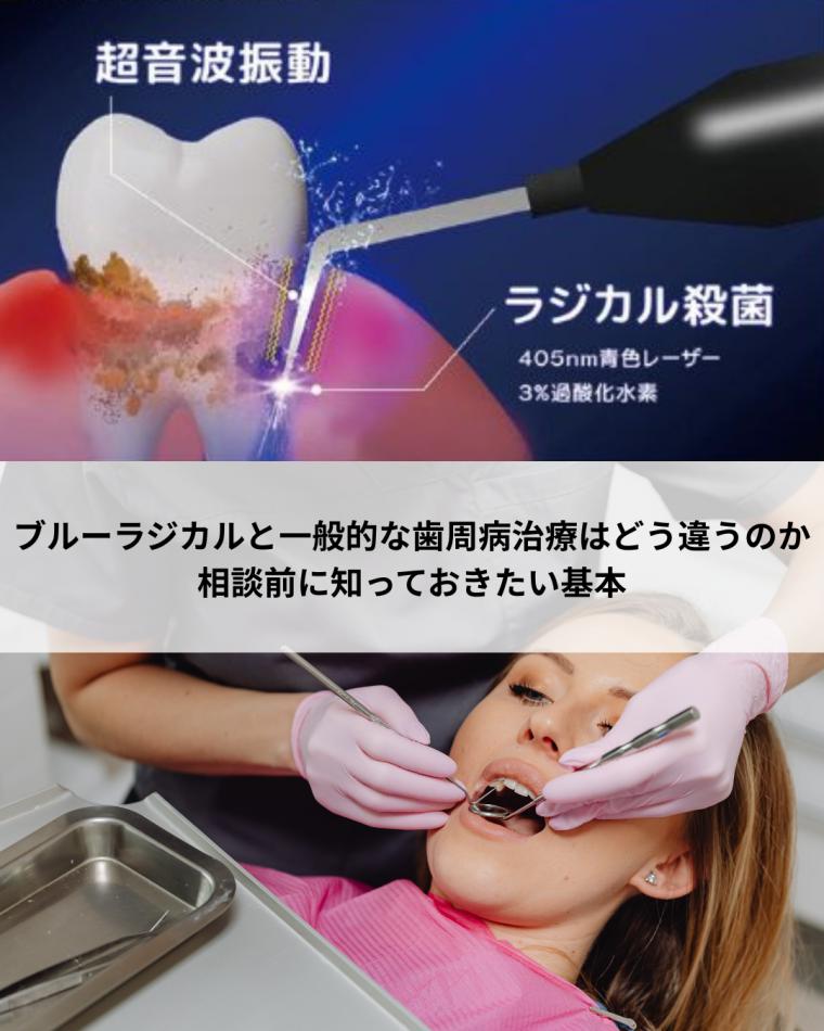 ブルーラジカルと一般的な歯周病治療はどう違うのか｜相談前に知っておきたい基本