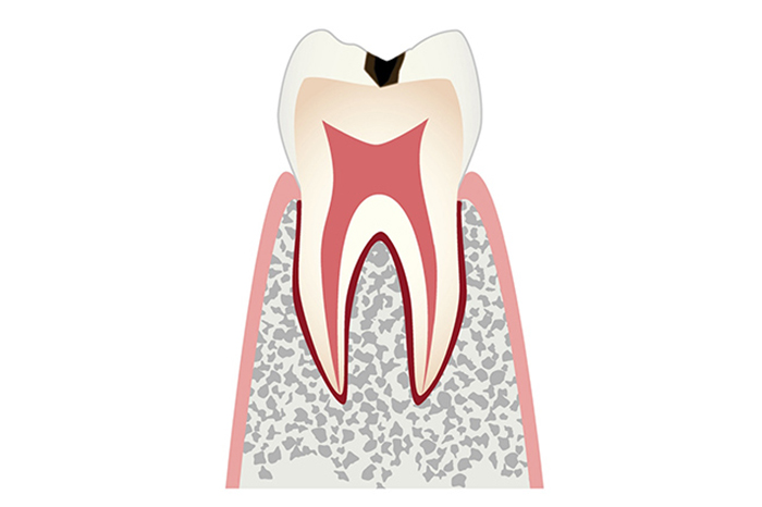 エナメル質に穴があいている状態（C1）