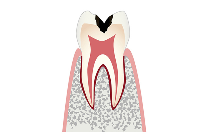 感染が象牙質に達している状態（C2）