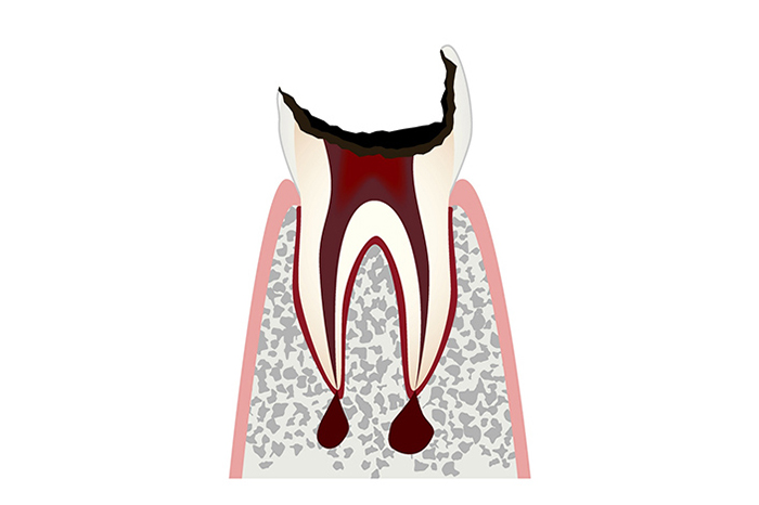 歯根しか残っていない状態（C4）