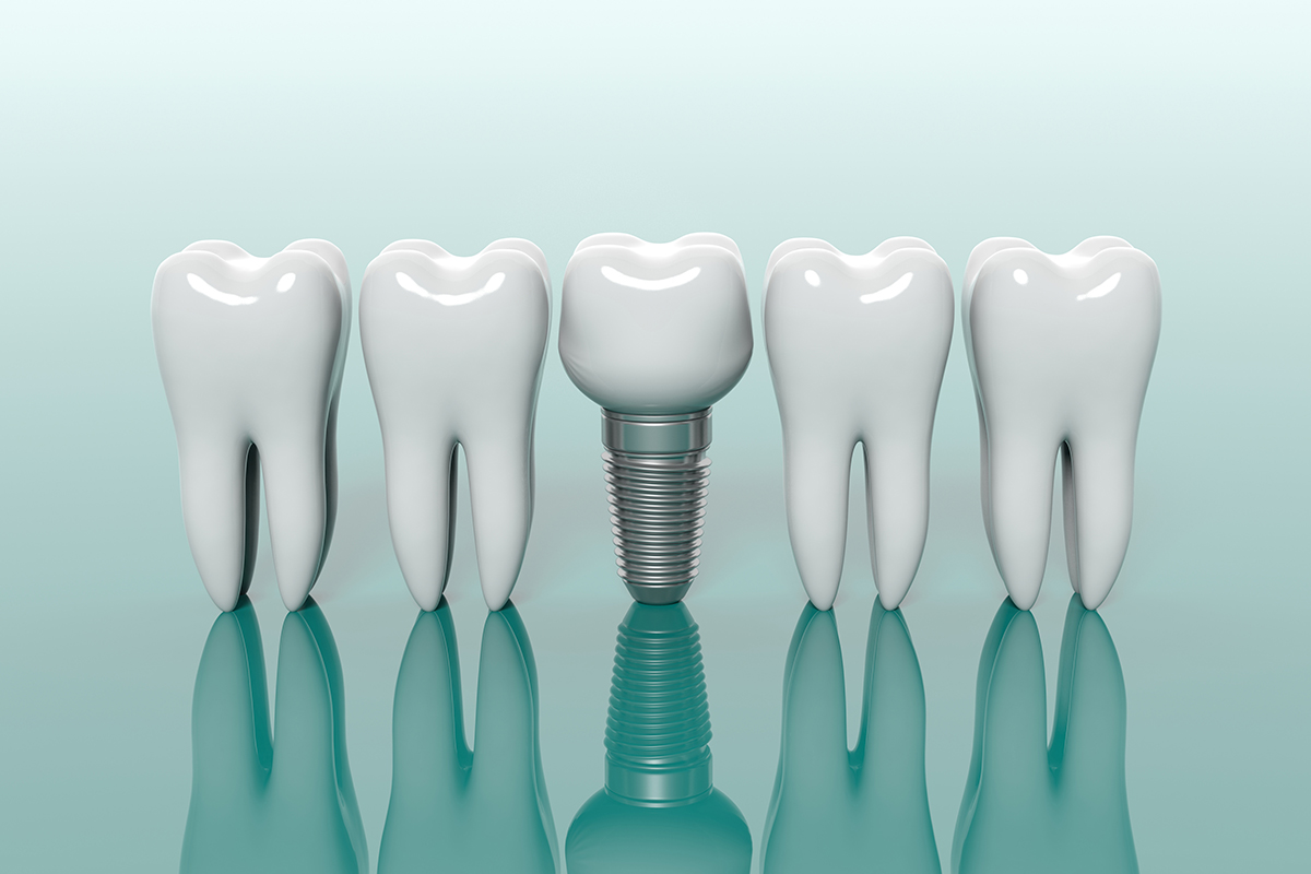 ならや　歯内、麻酔、衛生、インプラント 歯科医師国家試験】インプラント学 | DENTAL YOUTH