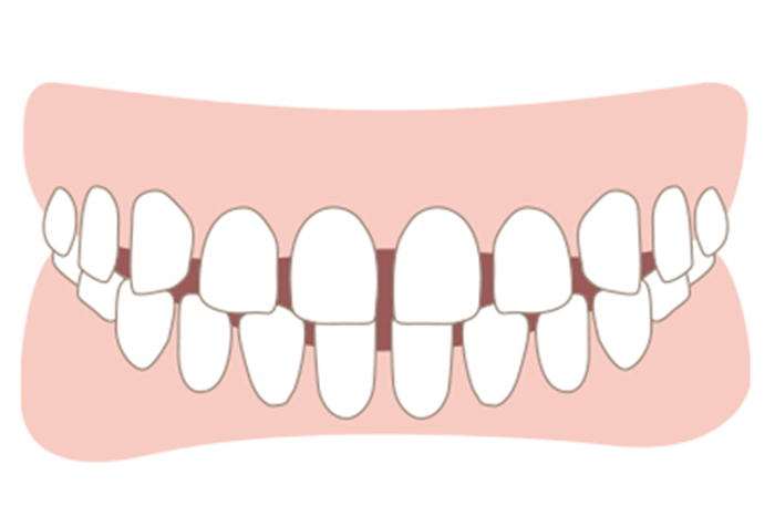 空隙歯列