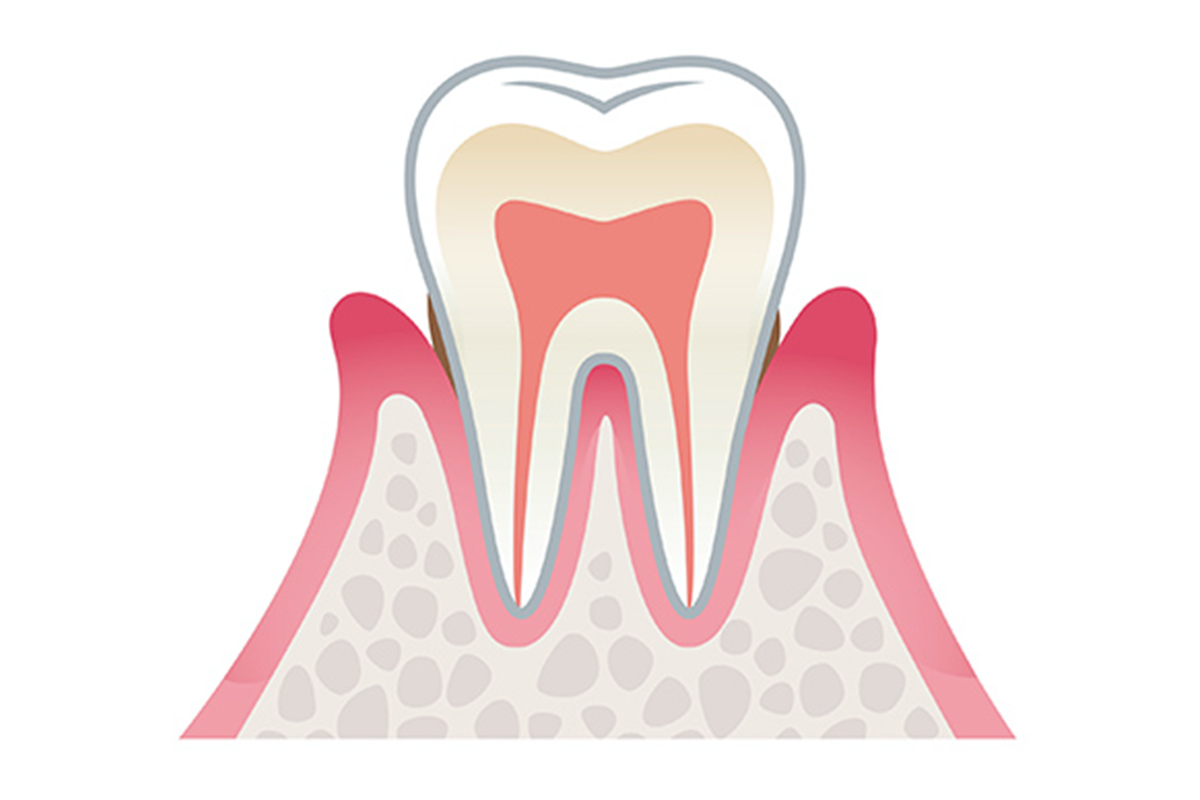 軽度の歯周病