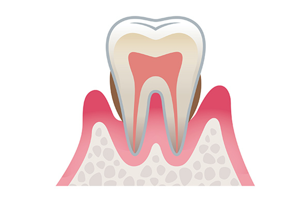 中等度の歯周病