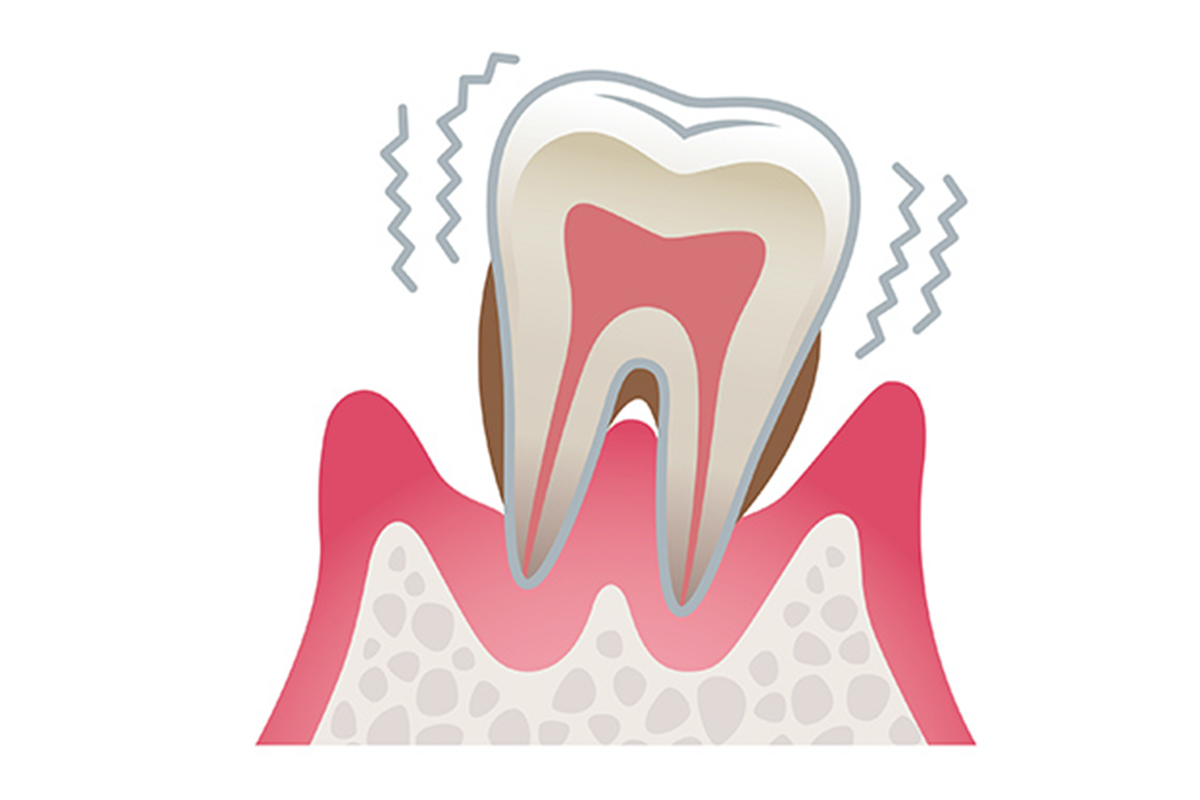重度の歯周病